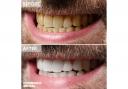 Teeth whitening in Turkey at Cosmedica Dental