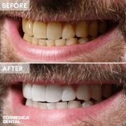 Teeth whitening in Turkey at Cosmedica Dental